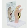 Model ruky s osteoartrózou (Anatomické modely) Model ruky s osteoartrózou (Anatomické modely)