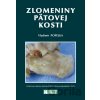 Zlomeniny pätovej kosti - Vladimír Popelka Zlomeniny pätovej kosti - Vladimír Popelka