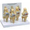 Kolenný kĺb, 4 stupne osteoartrózy (Anatomické modely) Kolenný kĺb, 4 stupne osteoartrózy (Anatomické modely)