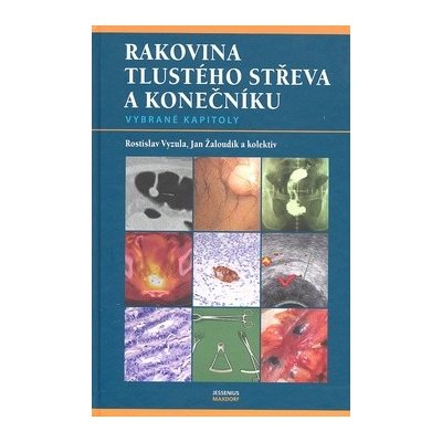 Rakovina tlustého střeva a konečníku - Rostislav Vyzula, Jan Žaloudík – Zboží Mobilmania