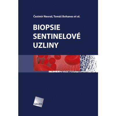 Biopsie sentinelové uzliny – Sleviste.cz