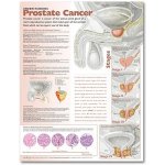 Rakovina prostaty 50,8x66cm – Hledejceny.cz