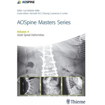 AOSpine Master Series - Adult Spinal Deformities