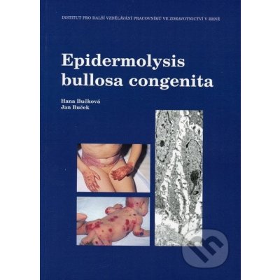 Epidermolysis bullosa congenita Hana Bučková, Jan Buček – Hledejceny.cz