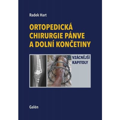 Ortopedická chirurgie pánve a dolní končetiny - Vzácnější kapitoly - Hart Radek