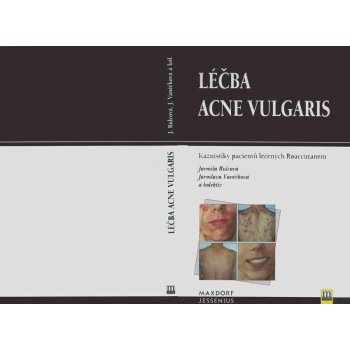 Léčba acne vulgaris