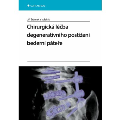 Chirurgická léčba degenerativního postižení bederní páteře – Zbozi.Blesk.cz