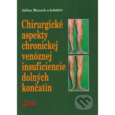 Chirurgické aspekty chronickej venóznej insuficiencie dolných končatín Július Mazuch a kol.
