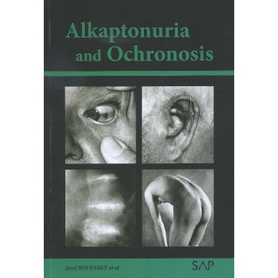Alkaptonuria and ochronosi