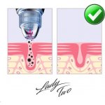 Vigan Lady Two Vakuový čistič pleti s mikrodermální abrazí – Zboží Dáma