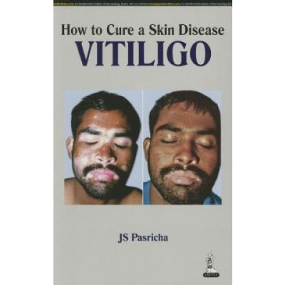 How to Cure a Skin Disease: Vitiligo – Zbozi.Blesk.cz