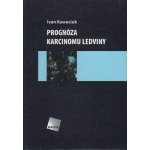 Prognóza karcinomu ledviny – Hledejceny.cz