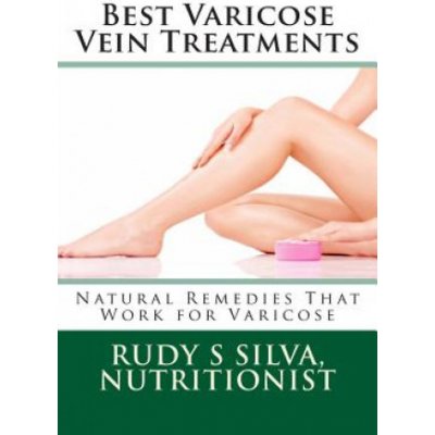 Best Varicose Vein Treatments: Natural Remedies That Work for Varicose – Zbozi.Blesk.cz