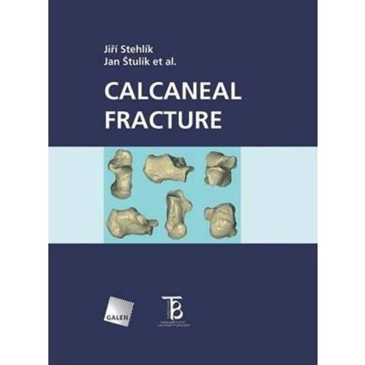 Calcaneal fracture - Štulík Jan