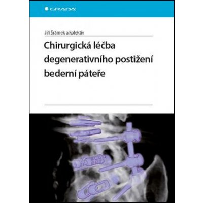 Chirurgická léčba degenerativního postižení bederní páteře – Zbozi.Blesk.cz