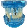 Verk 01964_N Model zubních implantátů modrá
