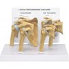 Model ramena, 4 stupne osteoartrózy (Anatomické modely)