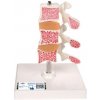 Model ľudských bedrových stavcov s osteoporózou (Anatomické modely)