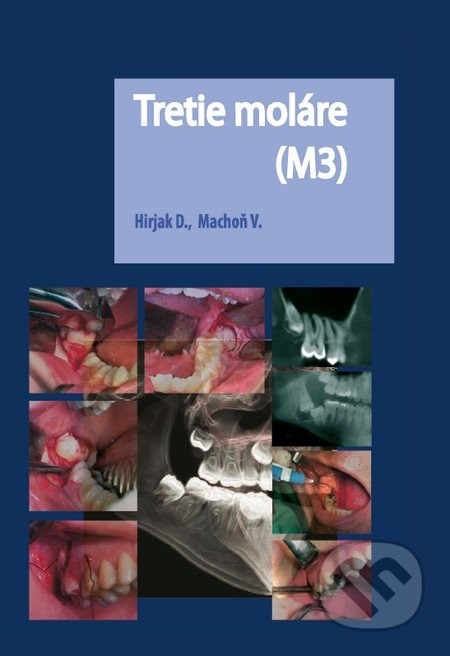 Tretie moláre M3