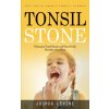 Tonsil Stones