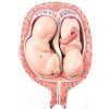 Model plodu dvojčiat, 5 mesiac, normálna poloha (Anatomické modely)