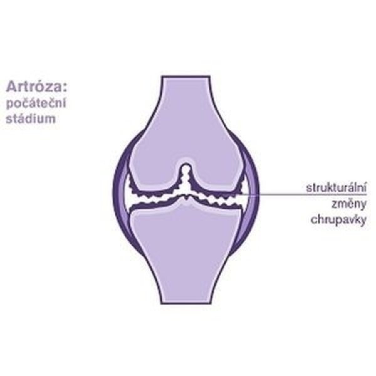 Čo je artróza?