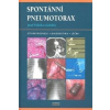 Spontánní pneumotorax - a kolektiv Vodička