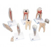 Klasický model zubov, 5 modelov (Anatomické modely)