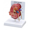 Model ochorenia obličiek (Anatomické modely)