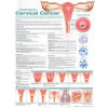 Understanding Cervical Cancer Anatomical Chart 2nd edition
