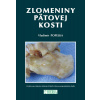 Zlomeniny pätovej kosti - Vladimír Popelka