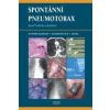 Spontánní pneumotorax Etiopatogeneze diagnostika a léčba - Vodička Josef a kolektiv